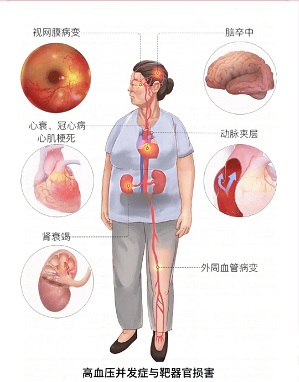 高血压并发症有哪些？太可怕了